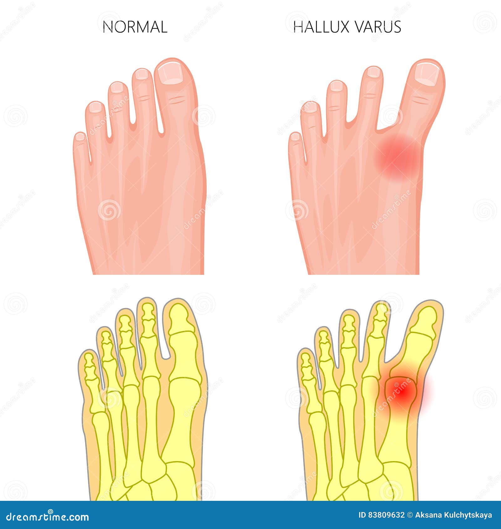normal foot and hallux varus
