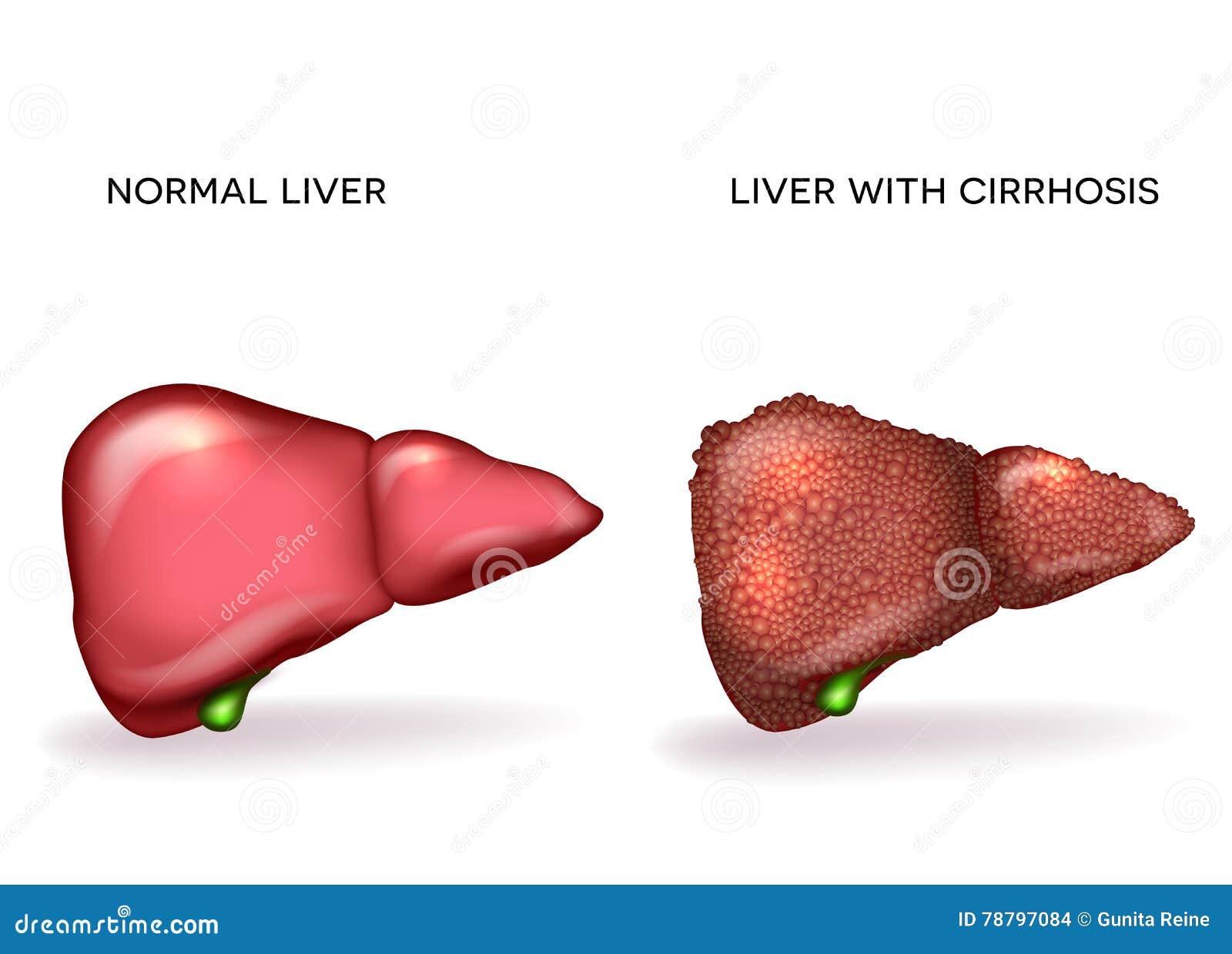 normal healthy liver and liver with cirrhosis