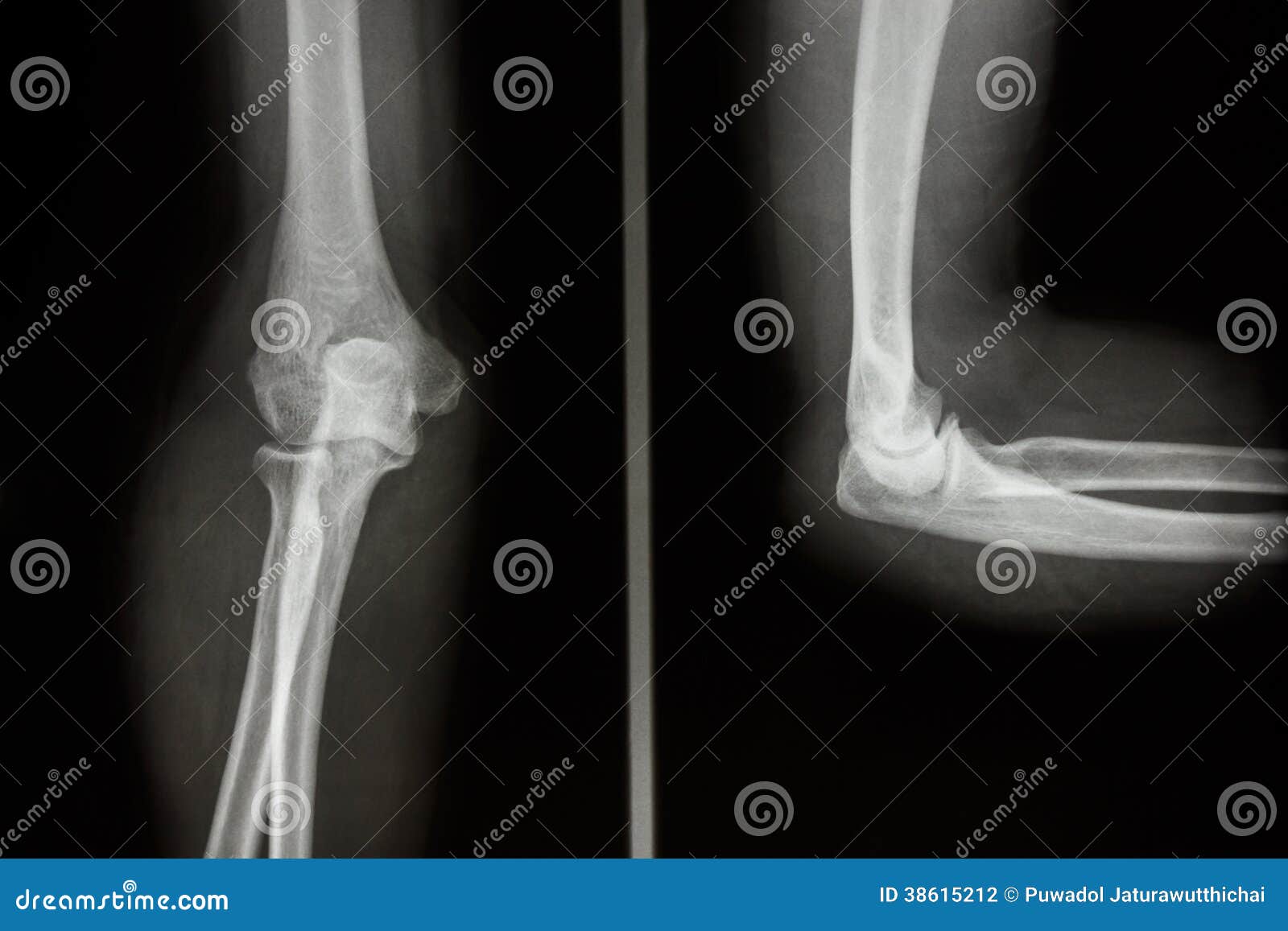 Normal Humans Elbow Stock Photography Image 38615212