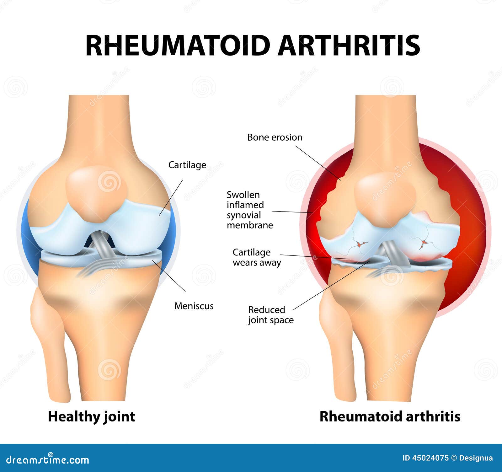 normal joint and rheumatoid arthritis