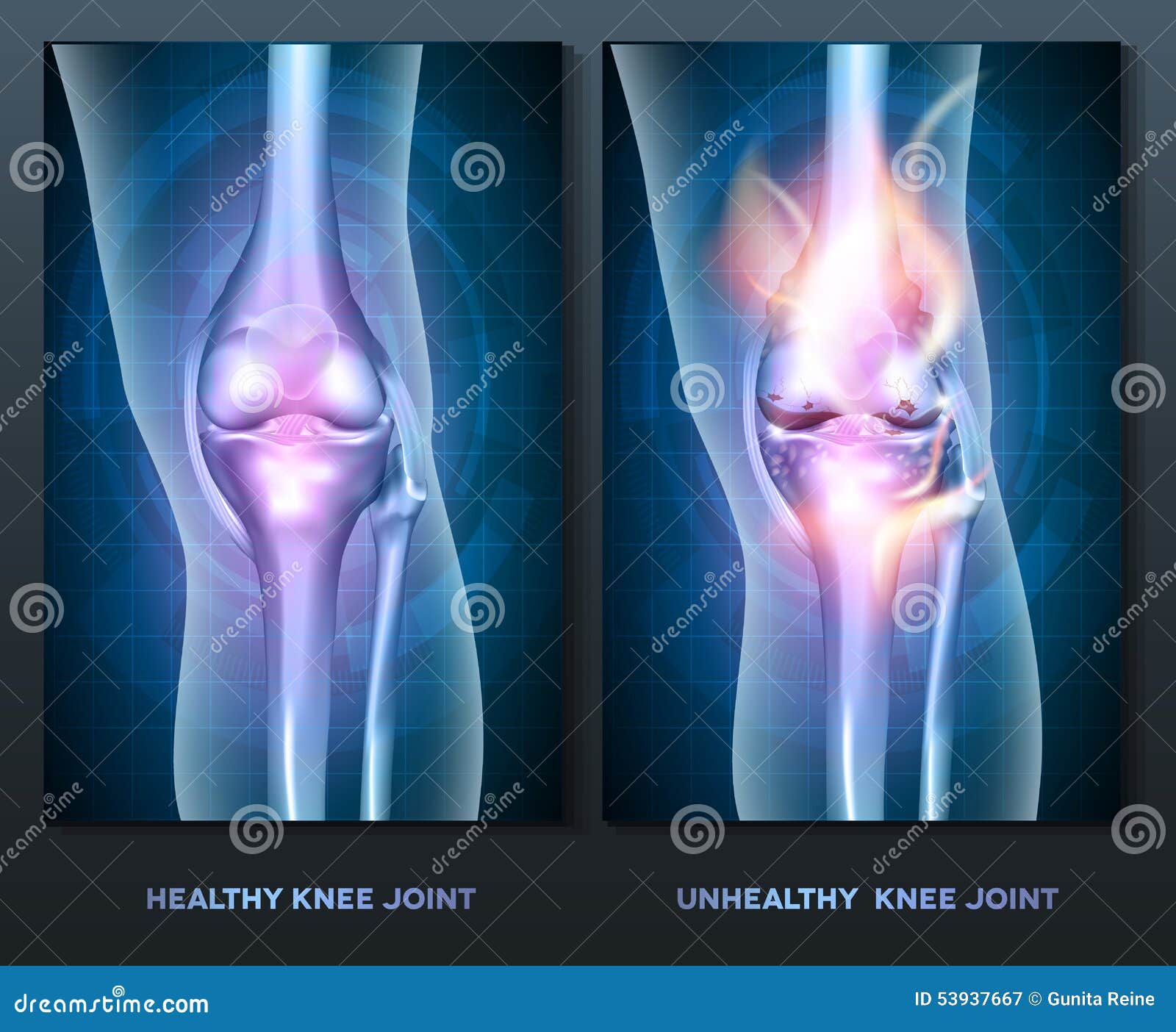 Burning Knee Vector Illustration 53466020