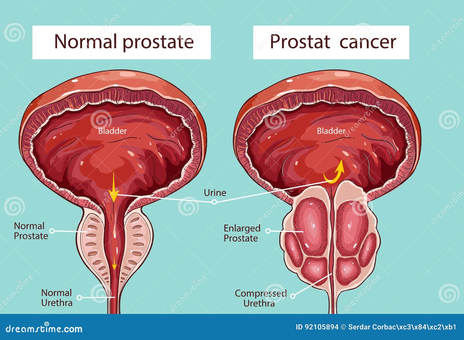 acute prostatitis and prostate cancer)