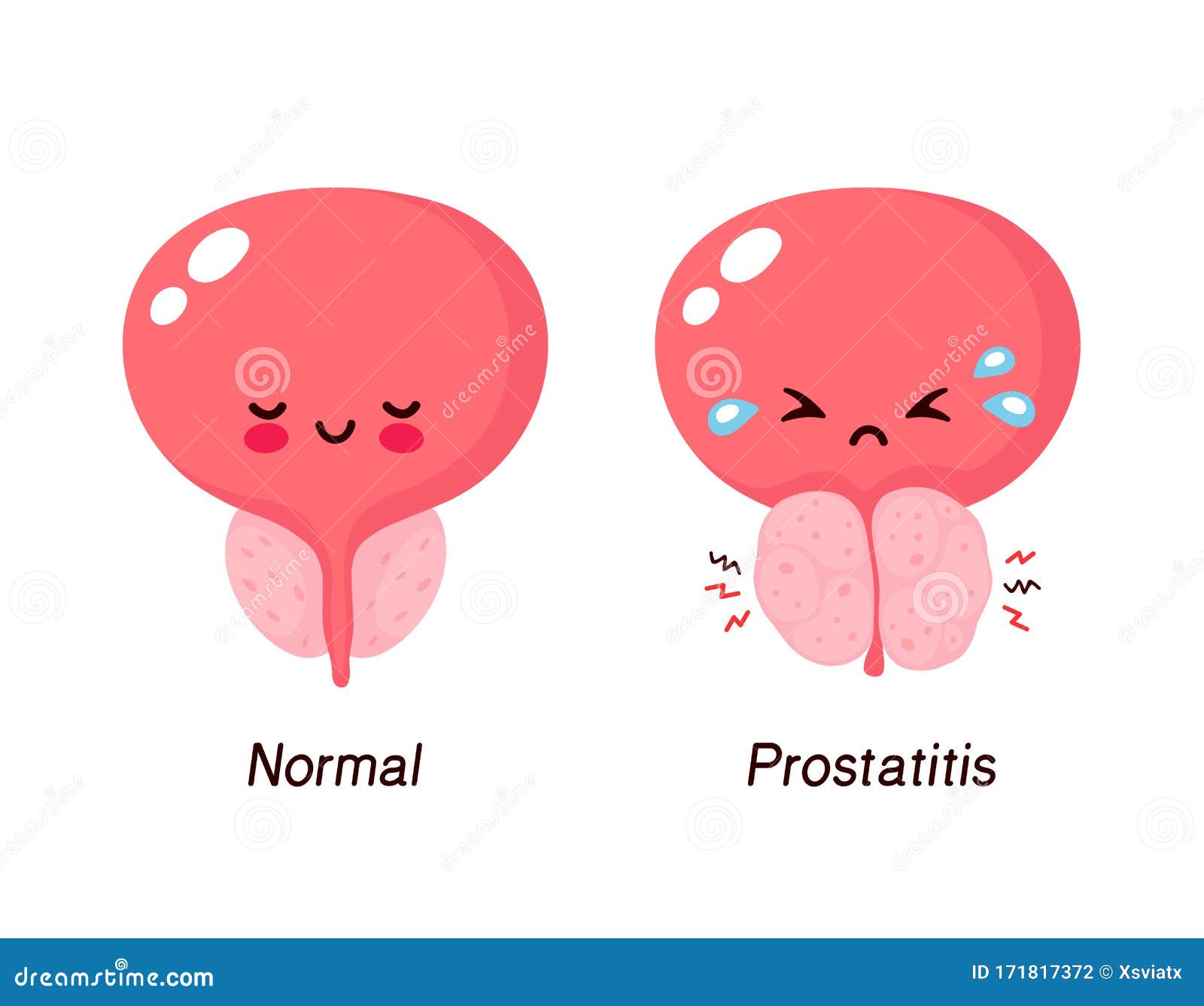 a prostatitis rák típusai