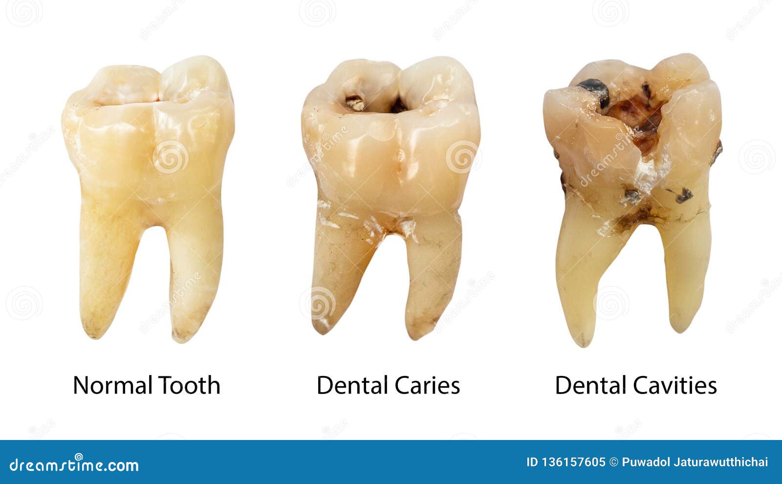 normal tooth , dental caries and dental cavity with calculus . comparison between difference of teeth decay stages . white