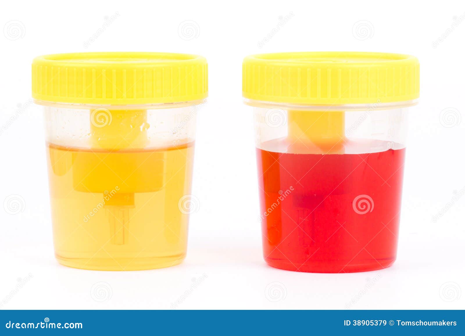 normal urine and bloody urine