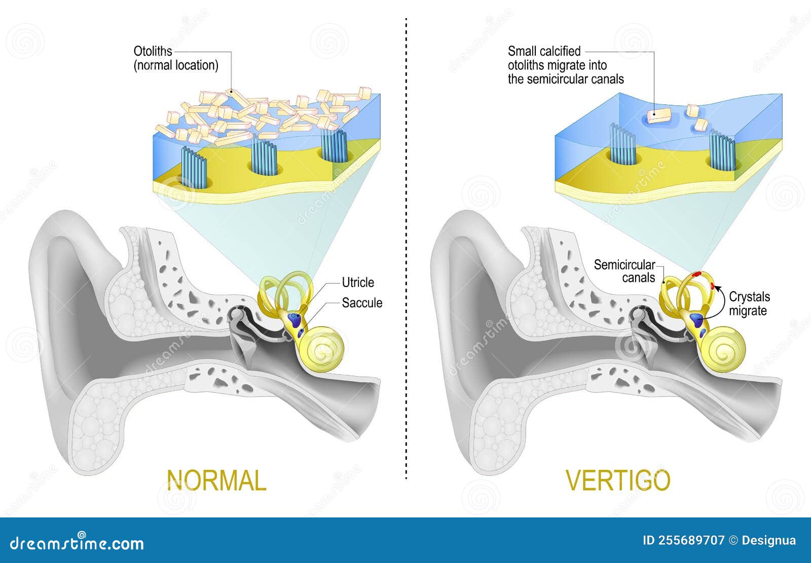 normal vestibular system and vertigo when small calcified otoliths migrate from saccule and utricle into the semicircular canals