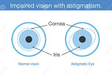 Normal Vision And Impaired Vision With Astigmatism In Front View. Stock 