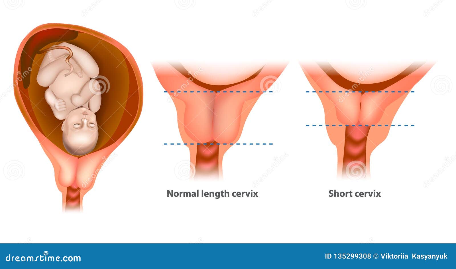 heerser Versterken Vaardig Normale Lengte En Korte Cervix Vector Illustratie - Illustration of  zwangerschap, baarmoederhals: 135299308