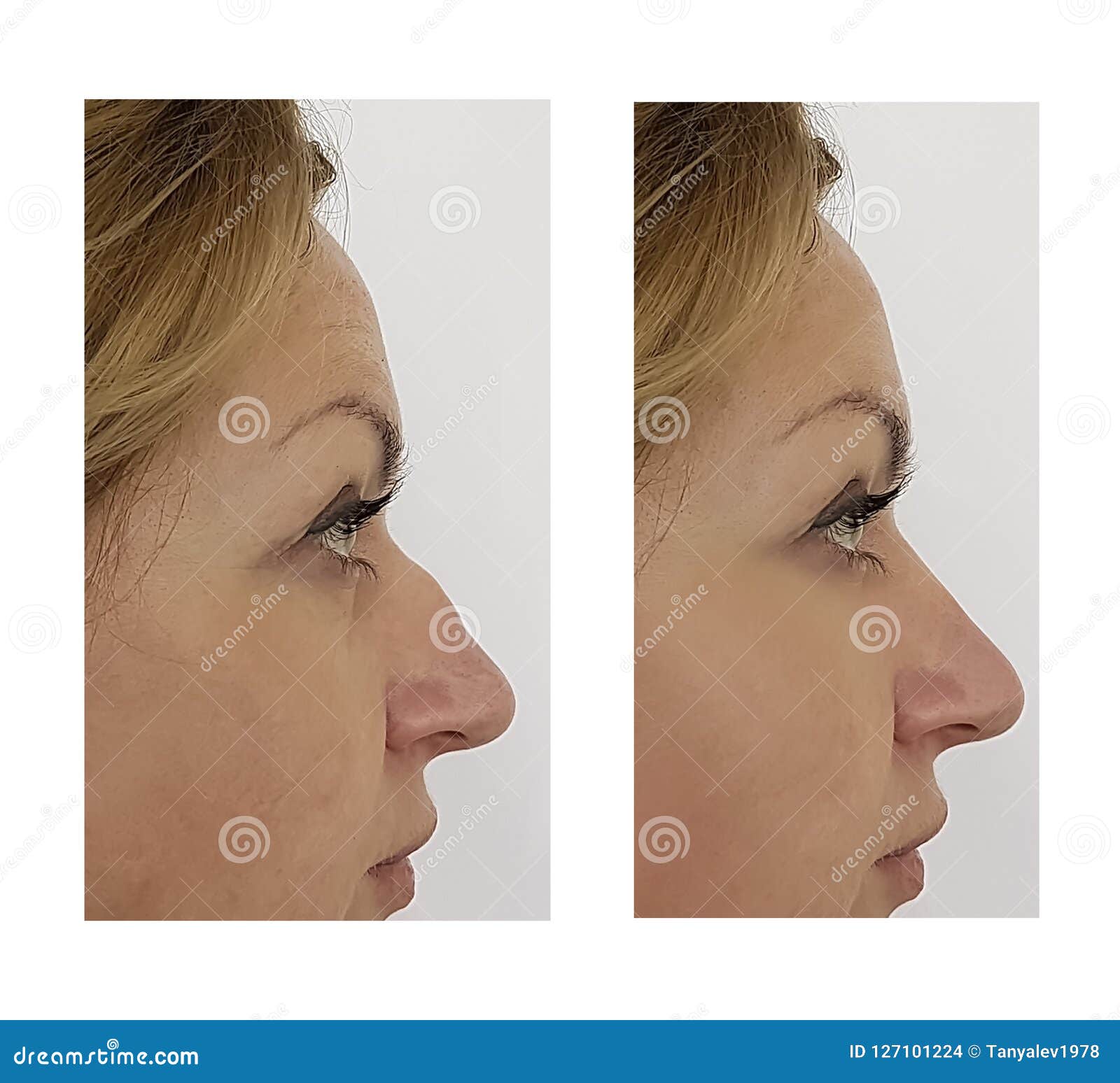 Nose Hump Correction before after Procedures Stock Photo Image of