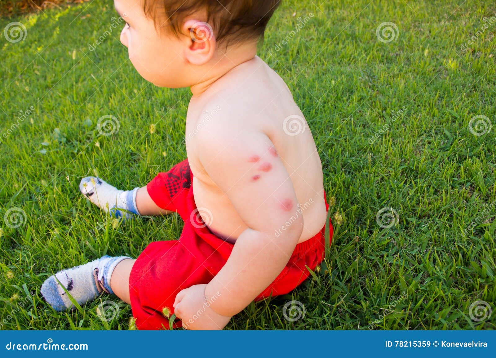 Nouveau Ne Avec Les Morsures De Moustique Multiples Allergie Aux Piqures D Insectes Image Stock Image Du Soin Degagement Nouveau Ne Avec Les Morsures De Moustique Multiples Allergie Aux Piqures D Insectes Image Stock Image Du Soin Degagement