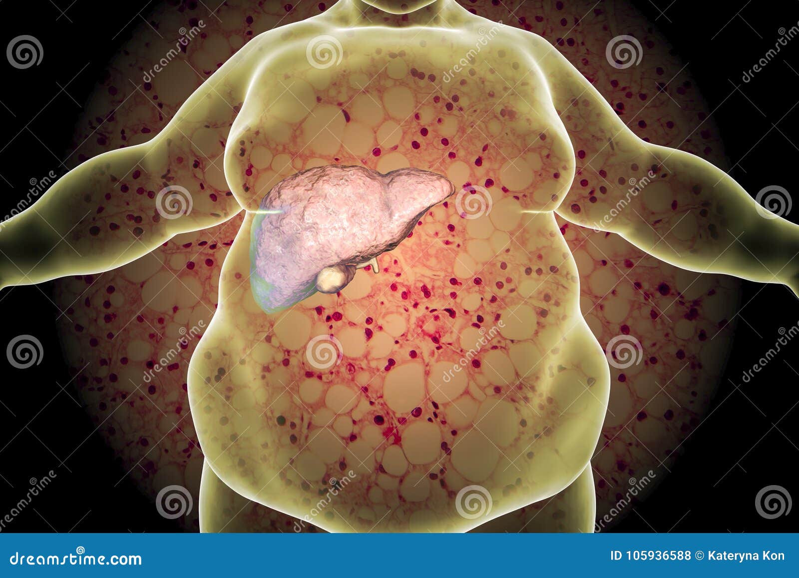 obese man with fatty liver