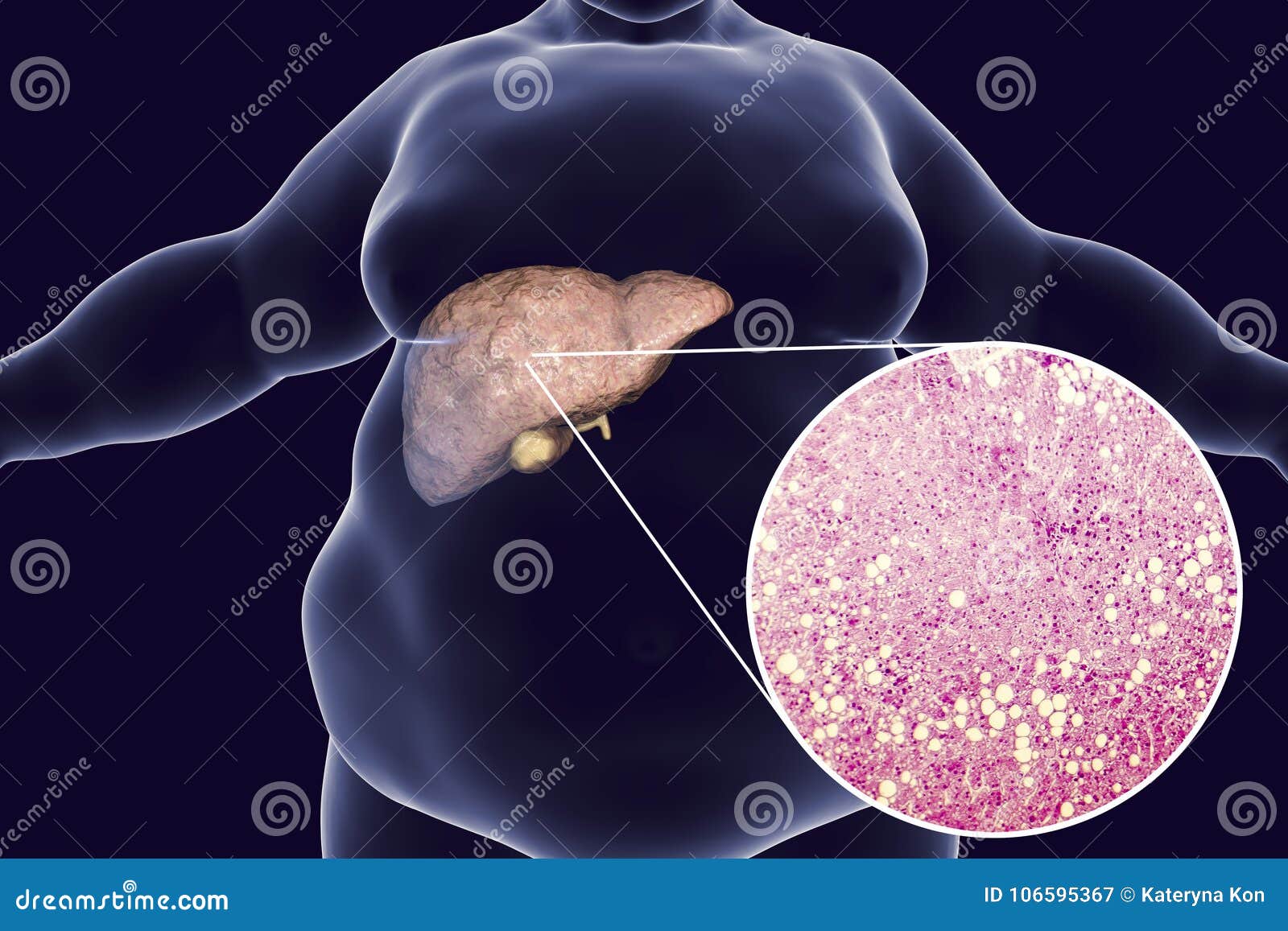 obese man with fatty liver