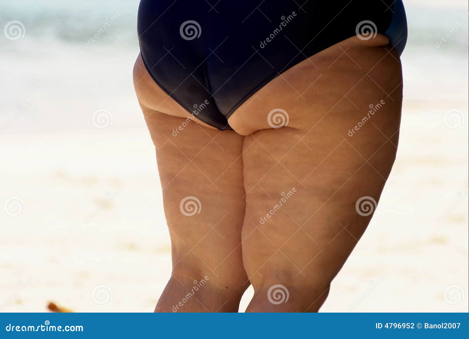 Obese Woman Cellulite Legs Stock Photo Image Of Fatten