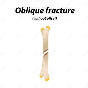 Oblique Without Offset Bone Fracture Infographics Vector 