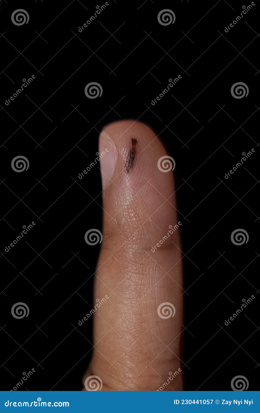 nevus on finger of asian woman