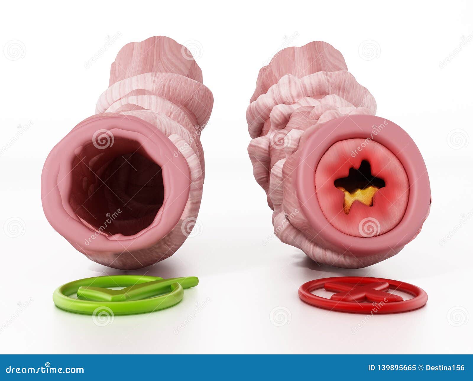 obstructed and unobstructed bronchial tubes representing asthma. 3d 