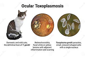 Toxoplasmosis Retinal Scar