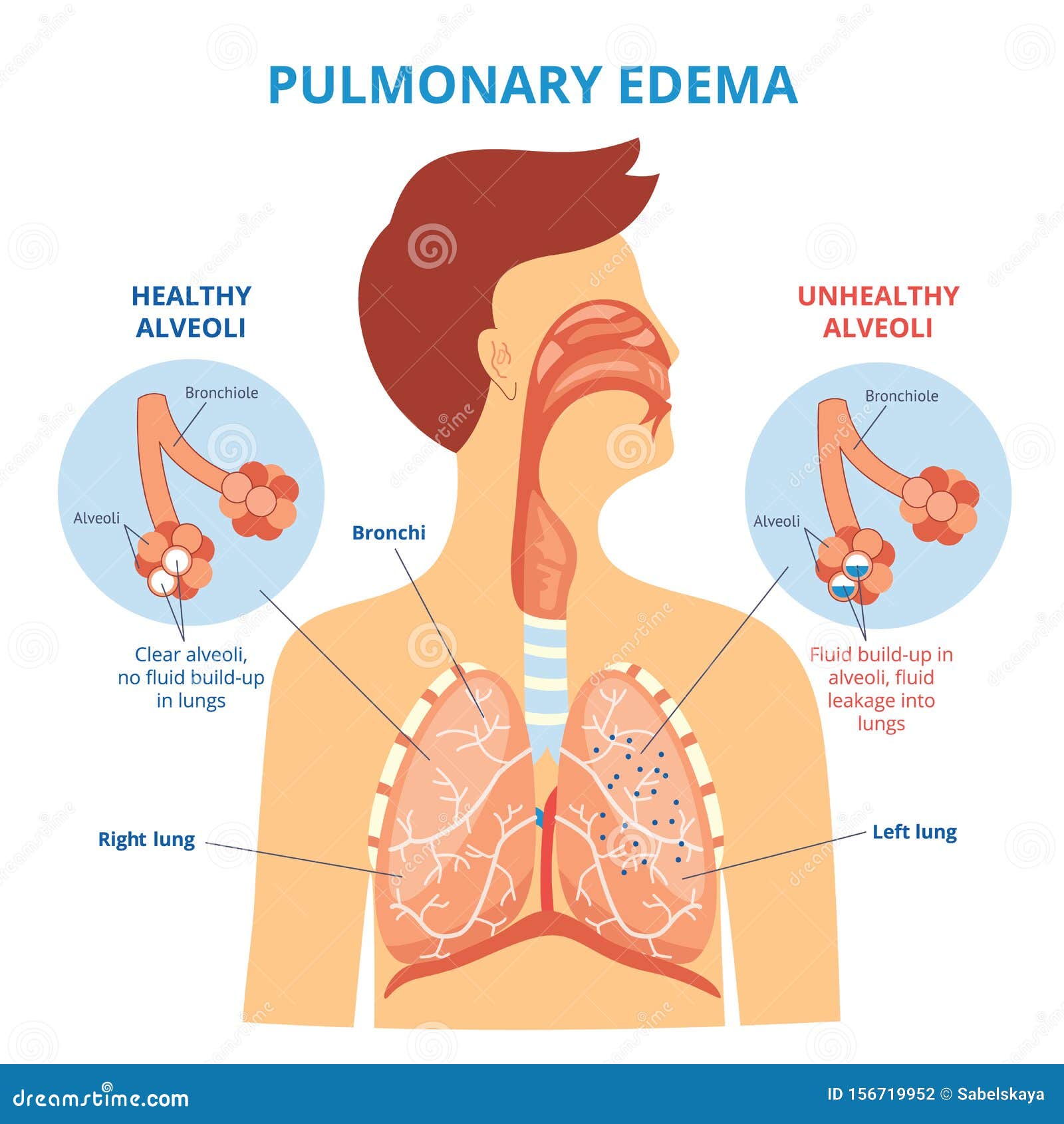 Oedème Pulmonaire - Infographie Sur Les Maladies Pulmonaires ...