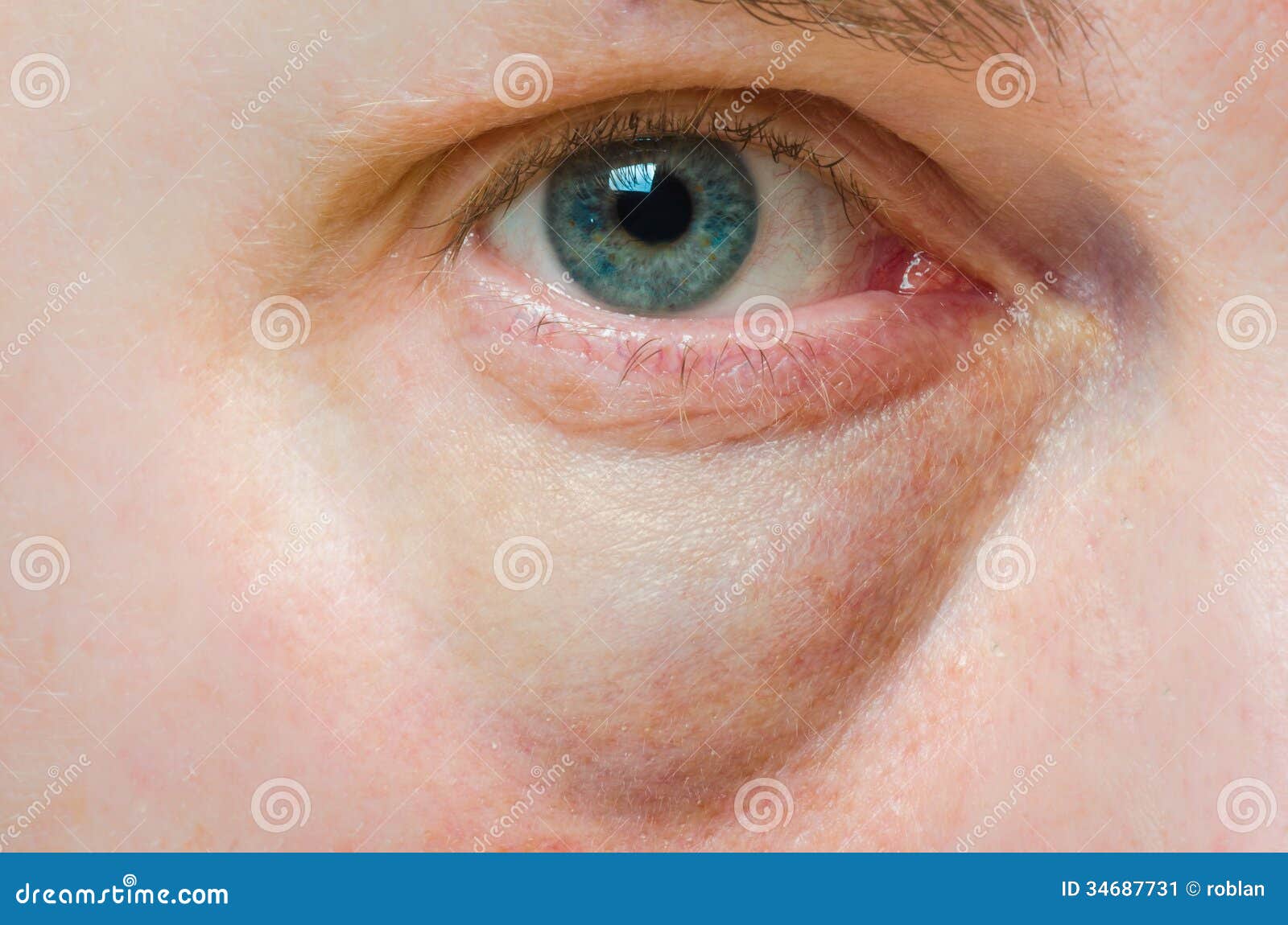 vochtzakje onder oog