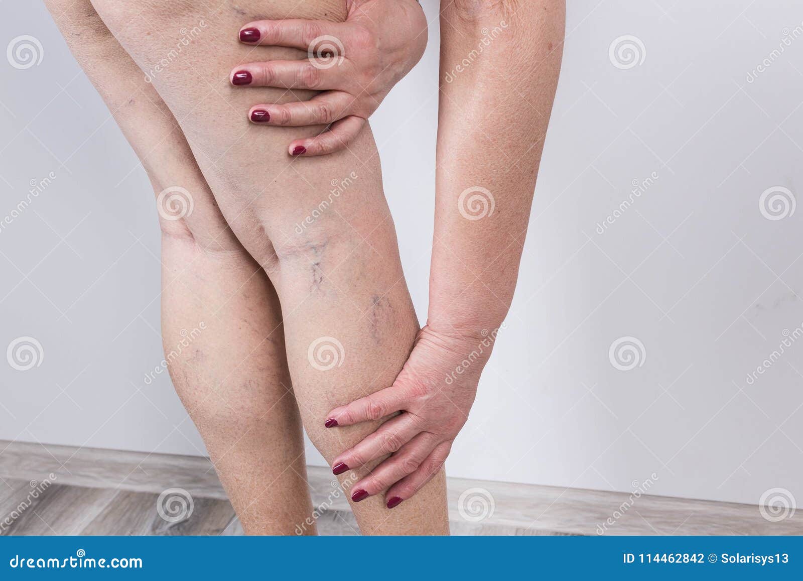 The Varicose Veins On A Legs Of Woman Stock Photo - Image of person, illness: 114462842