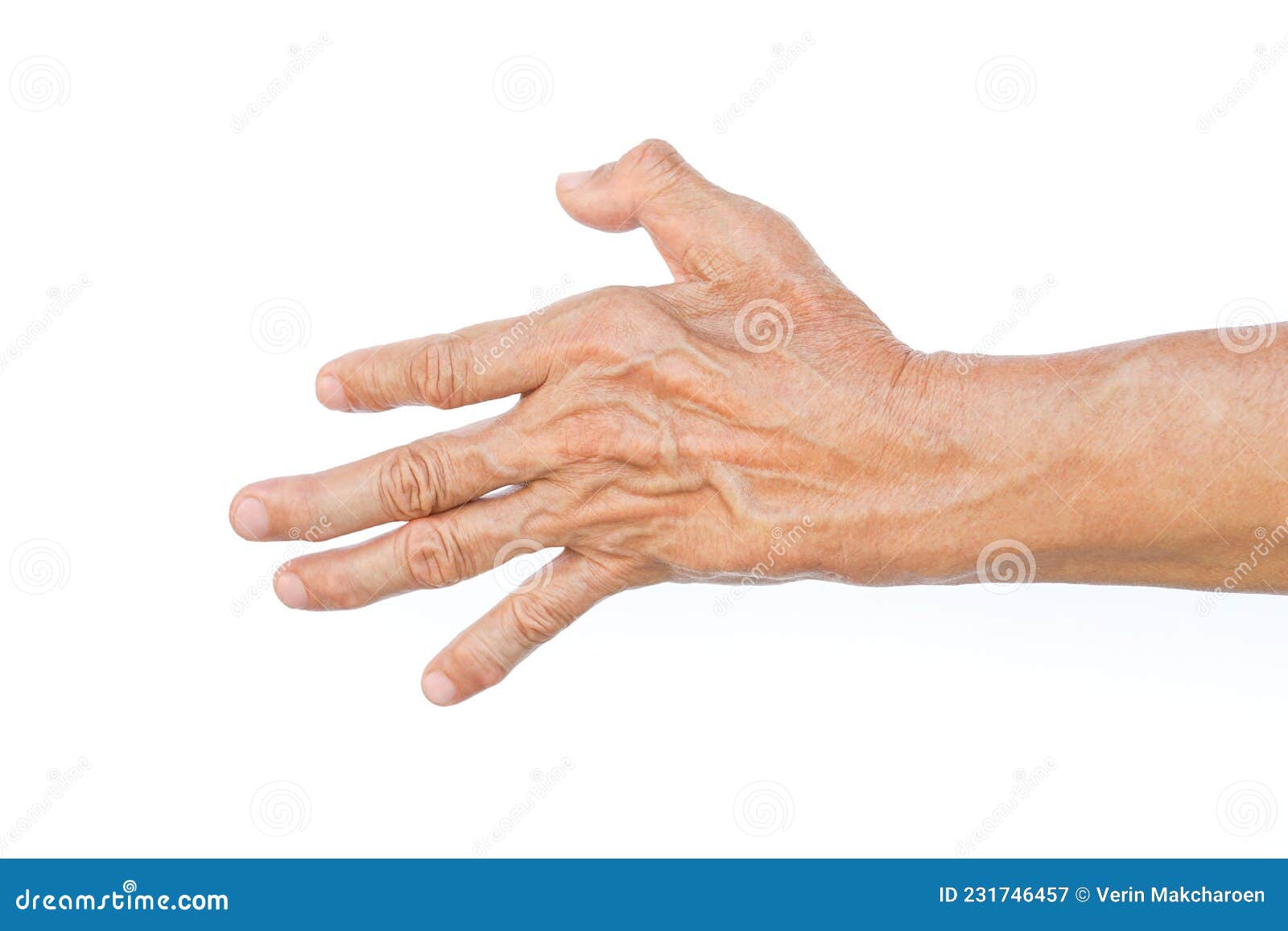 Hand Muscle Spasm In Asian Young Man Unilateral Hand Deformity hand-muscle-spasm-in-asian-young-man-unilateral-hand-deformity