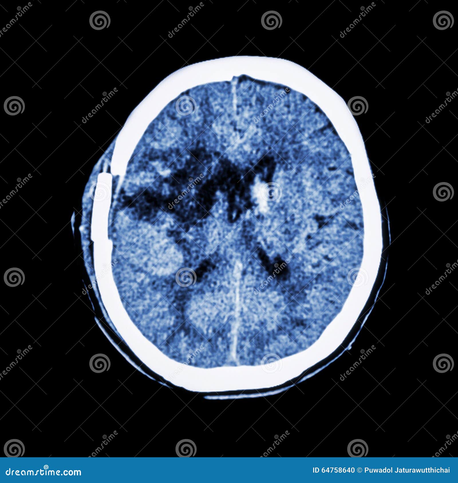 old right basal ganglia hemorrhage with brain edema ( status post craniotomy ) ( hemorrhagic stroke )
