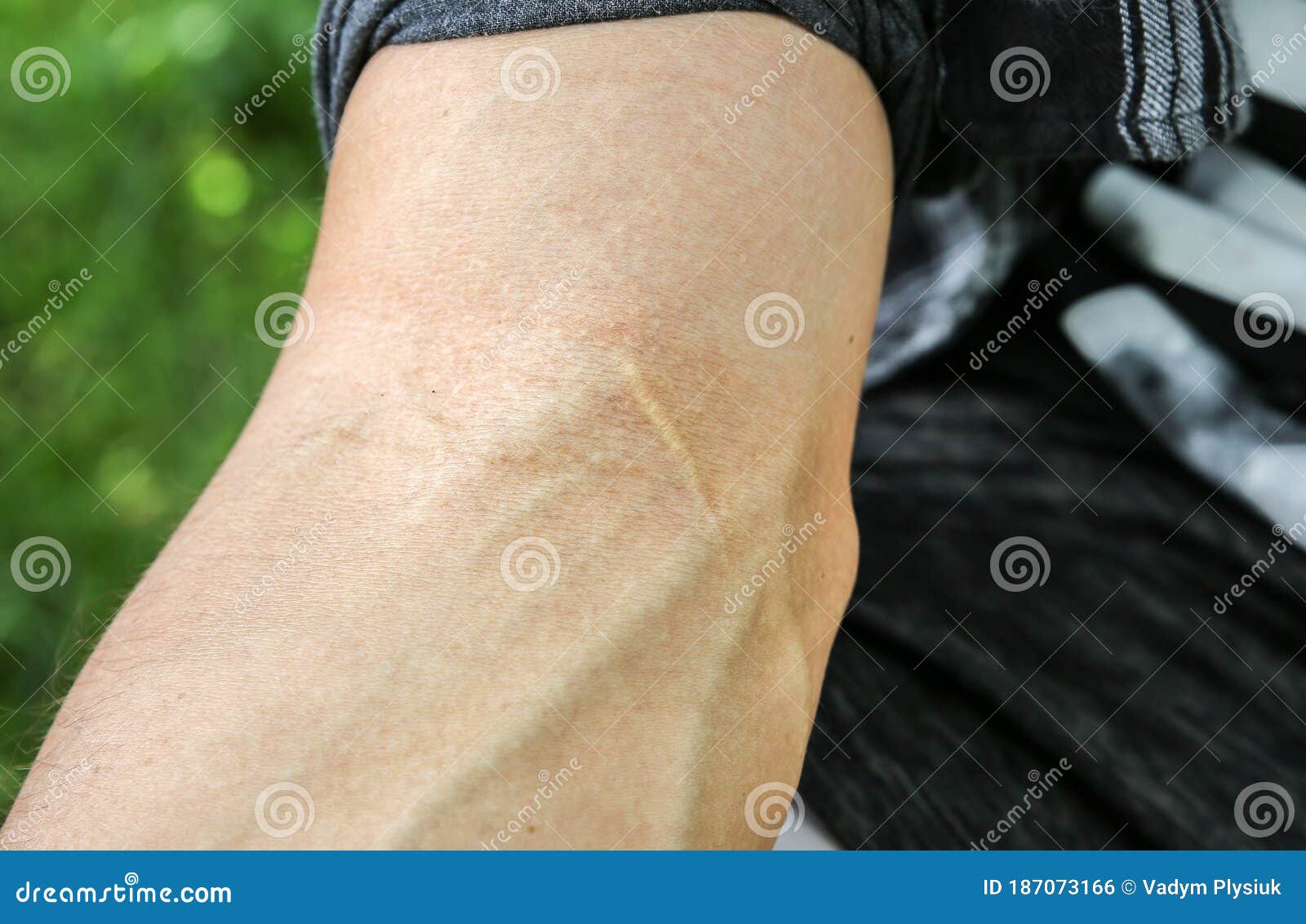 Old Scar on Man`s Arm. Accident in the Past Stock Photo Image of skin