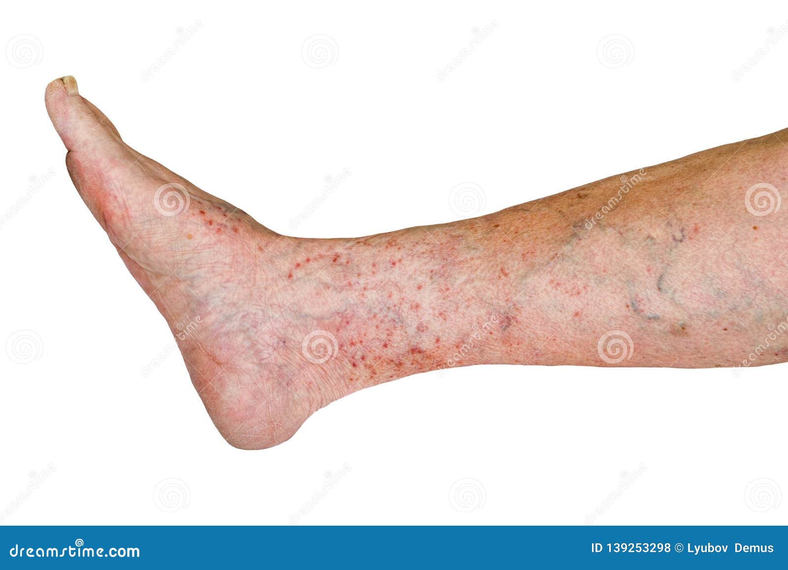 Old Woman`s Leg with Varicose Disease, Varicose Veins Isolated on