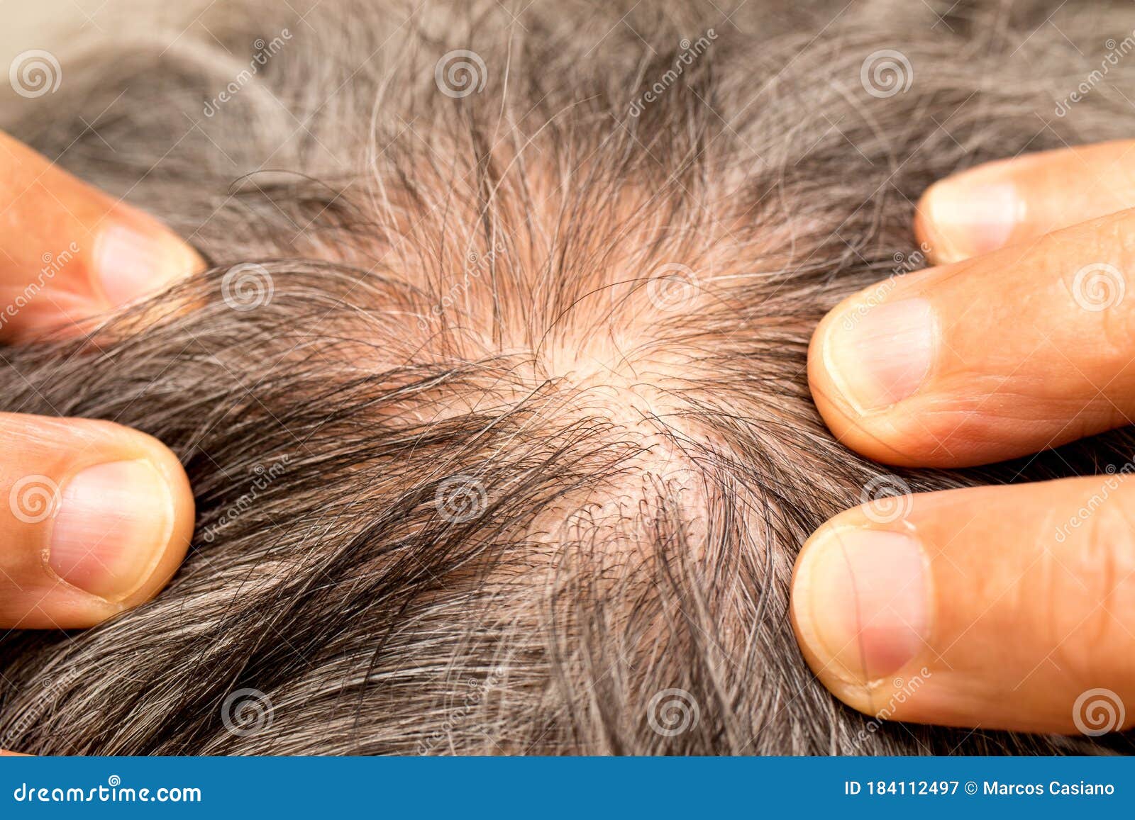 Man with Thinning Hair on the Back of His Head Around the Crown Stock Image  - Image of thinning, receding: 184112497