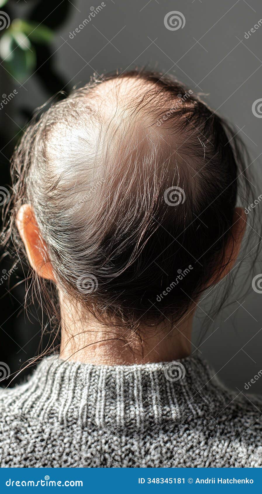 older woman with a diffuse thinning pattern her scalp increasingly exposed as hair thins