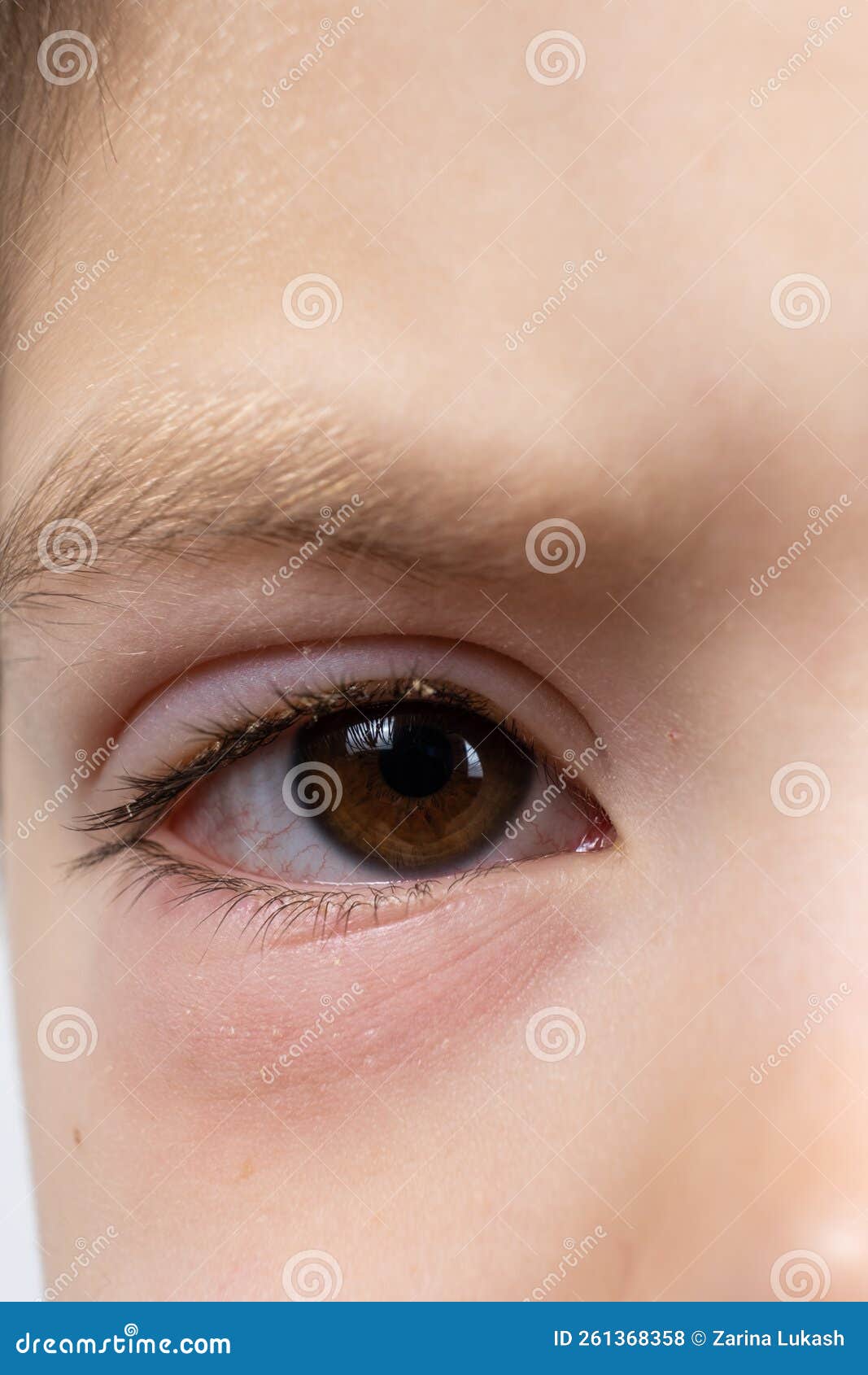 Olhos Irritados De Uma Menina Que Ficasse Doente Com Conjuntivite Foto de  Stock - Imagem de adolescente, inchado: 146506816