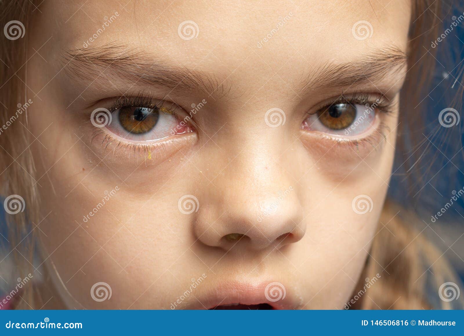 Olhos Irritados De Uma Menina Que Ficasse Doente Com Conjuntivite Foto de  Stock - Imagem de adolescente, inchado: 146506816