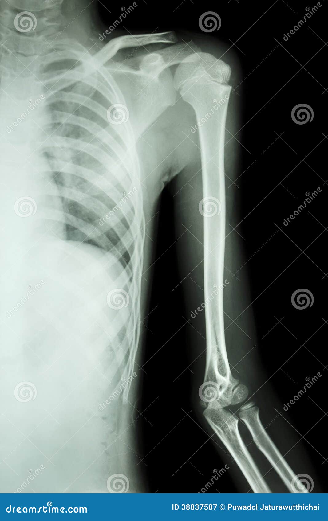 Radiografia Do Ombro Esquerdo Imagem de Stock - Imagem de preto, ciência:  38837587, image size:1067x1690