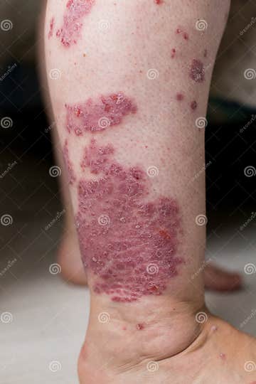 One Caucasian Woman With Psoriasis Eczema Atopic Dermatitis On The