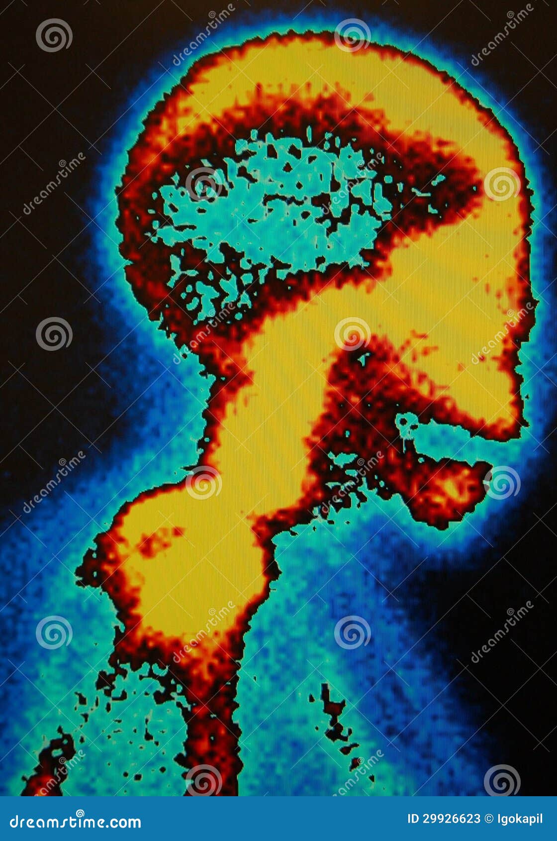 Nuclear medicine skull scan. One of the part of nuclear whole body scan for diagnostic purpose for patient with breast or prostate cancer