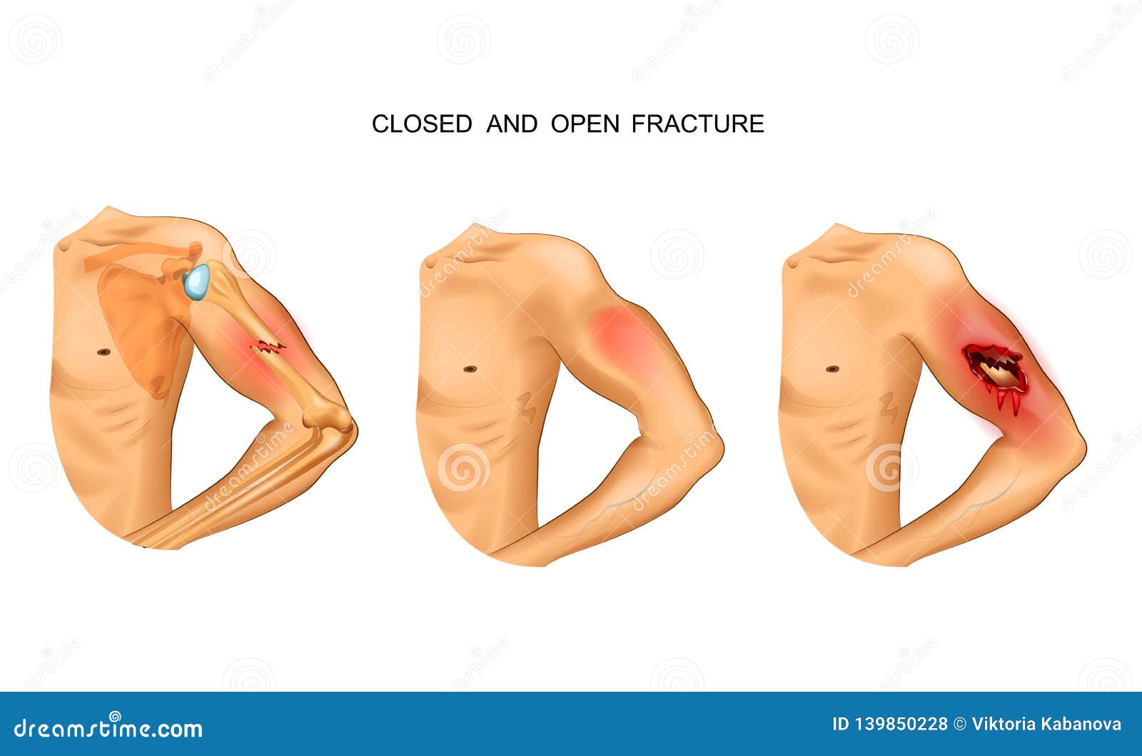 open and closed fracture