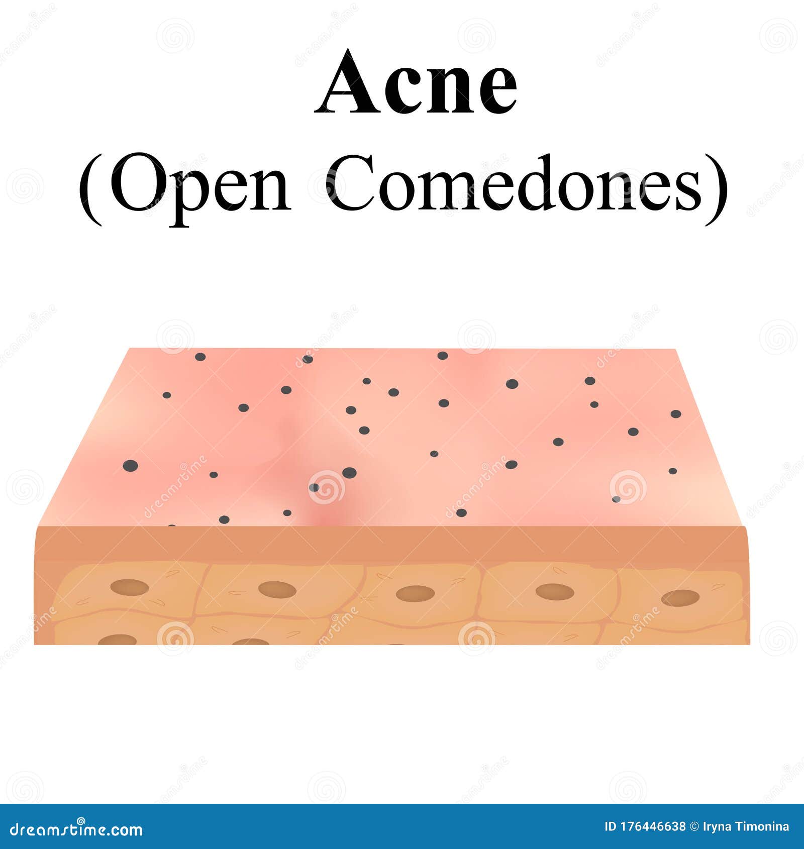 Open Comedones. Acne on the Skin. Dermatological and Cosmetic Diseases ...