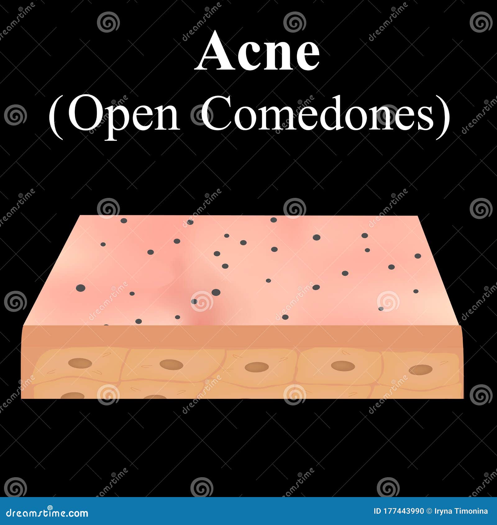 Open Comedones. Acne on the Skin. Dermatological and Cosmetic Diseases ...