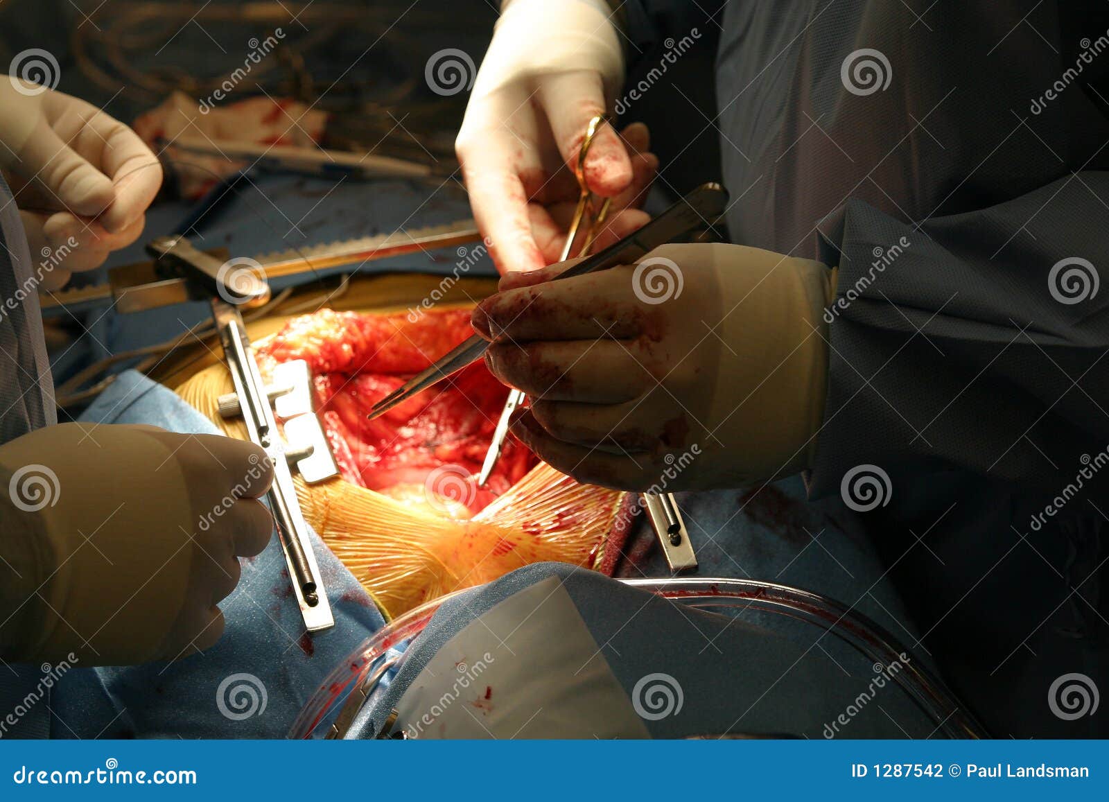 Open heart surgery stock photo. Image of cabg, healthcare - 1287542