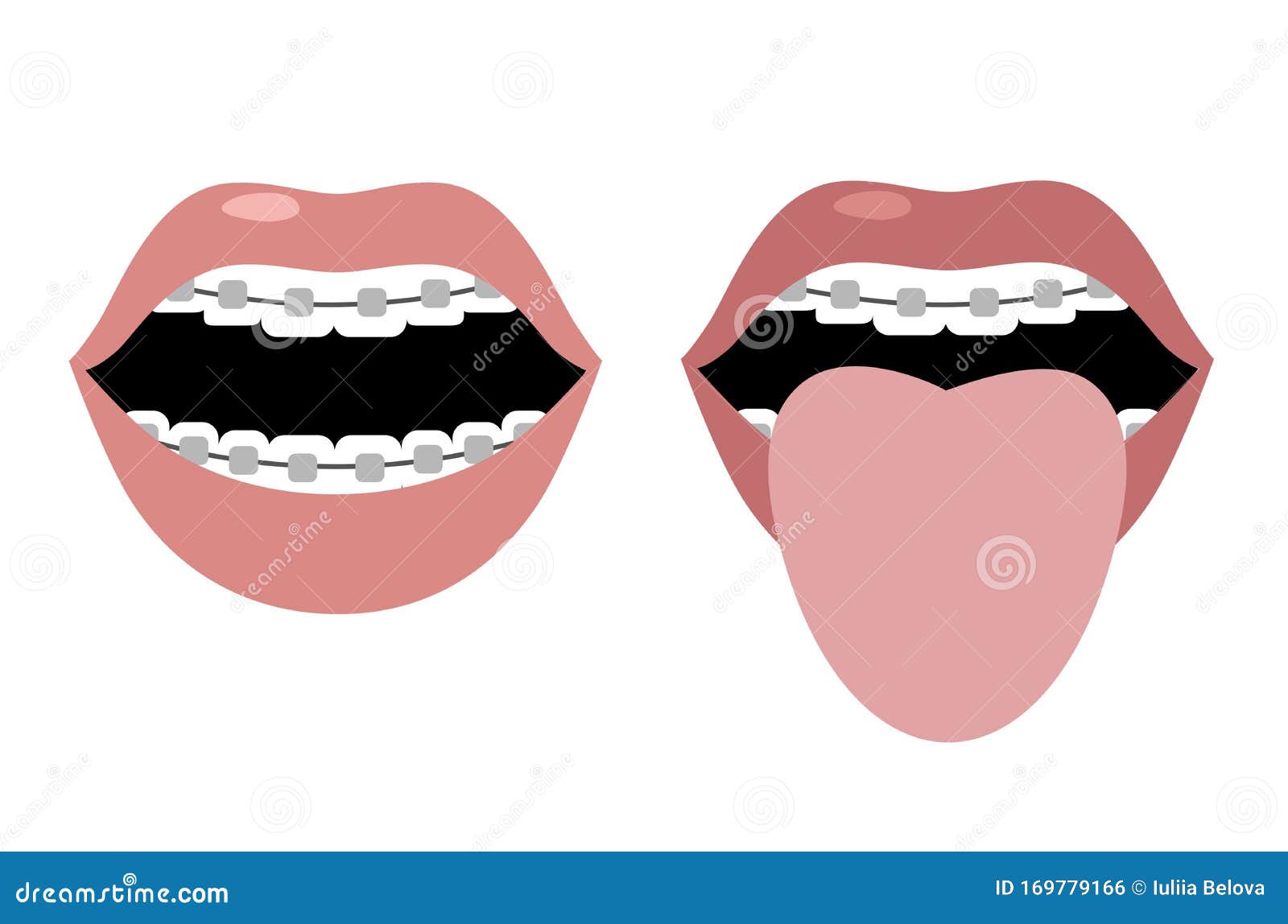 Open Mouth with Braces and Tongue Sticking Out Image. Flat Design Stock