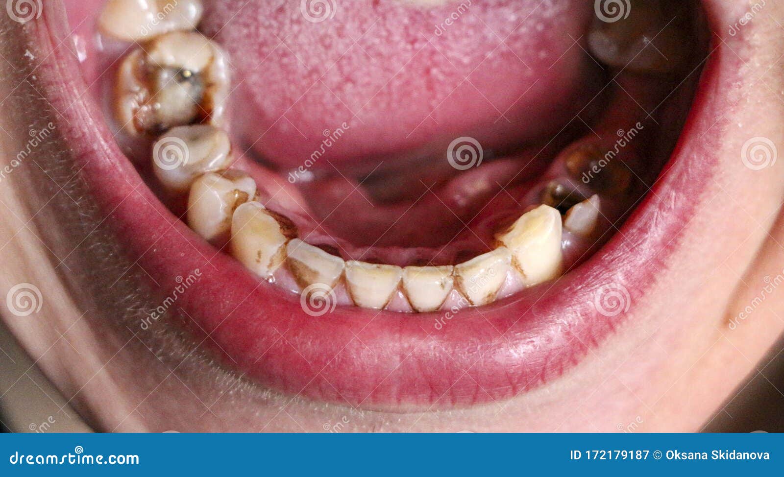 Dental X-ray With Periodontitis Problems Stock Image | CartoonDealer