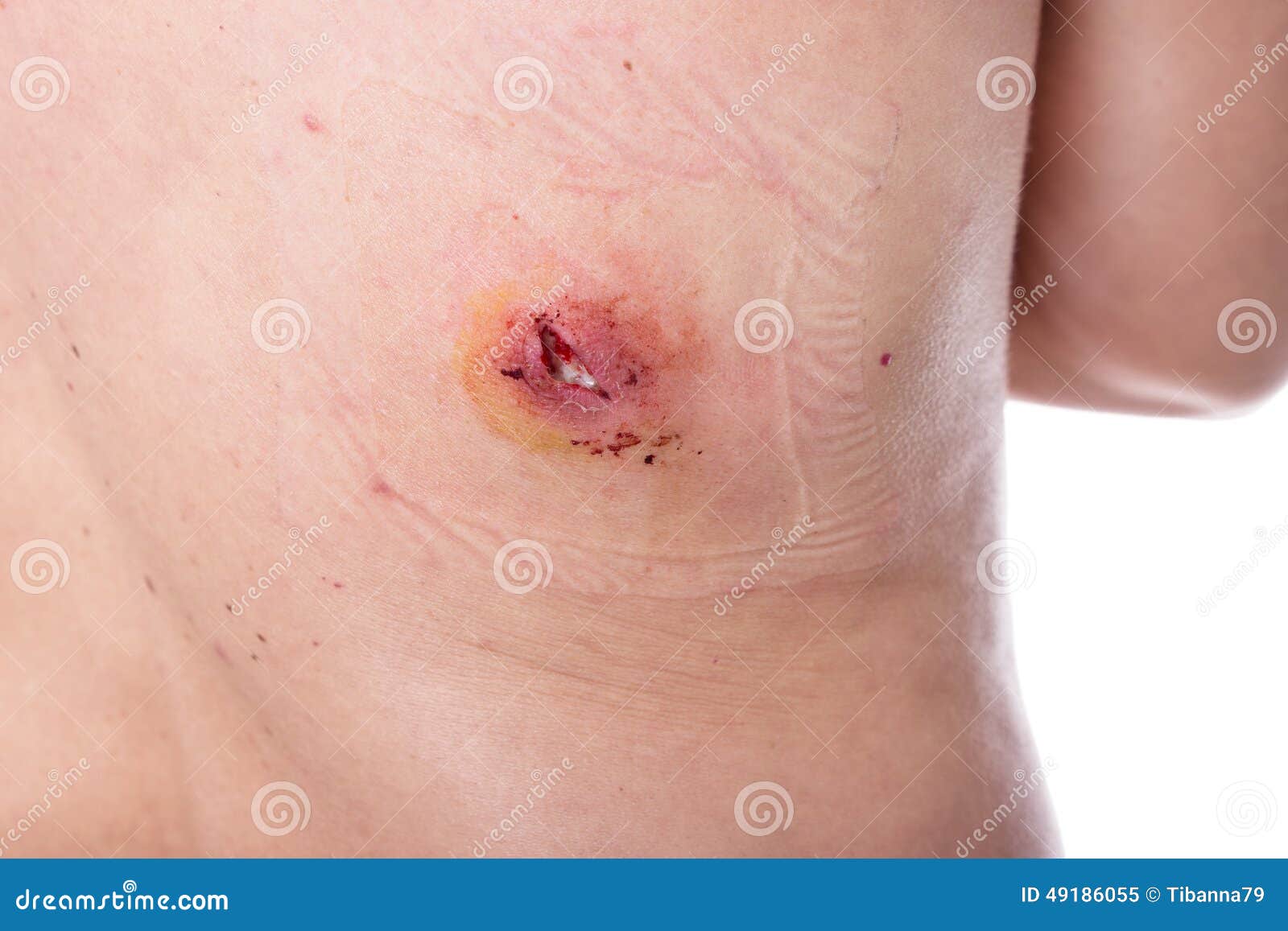 Open Wound Images