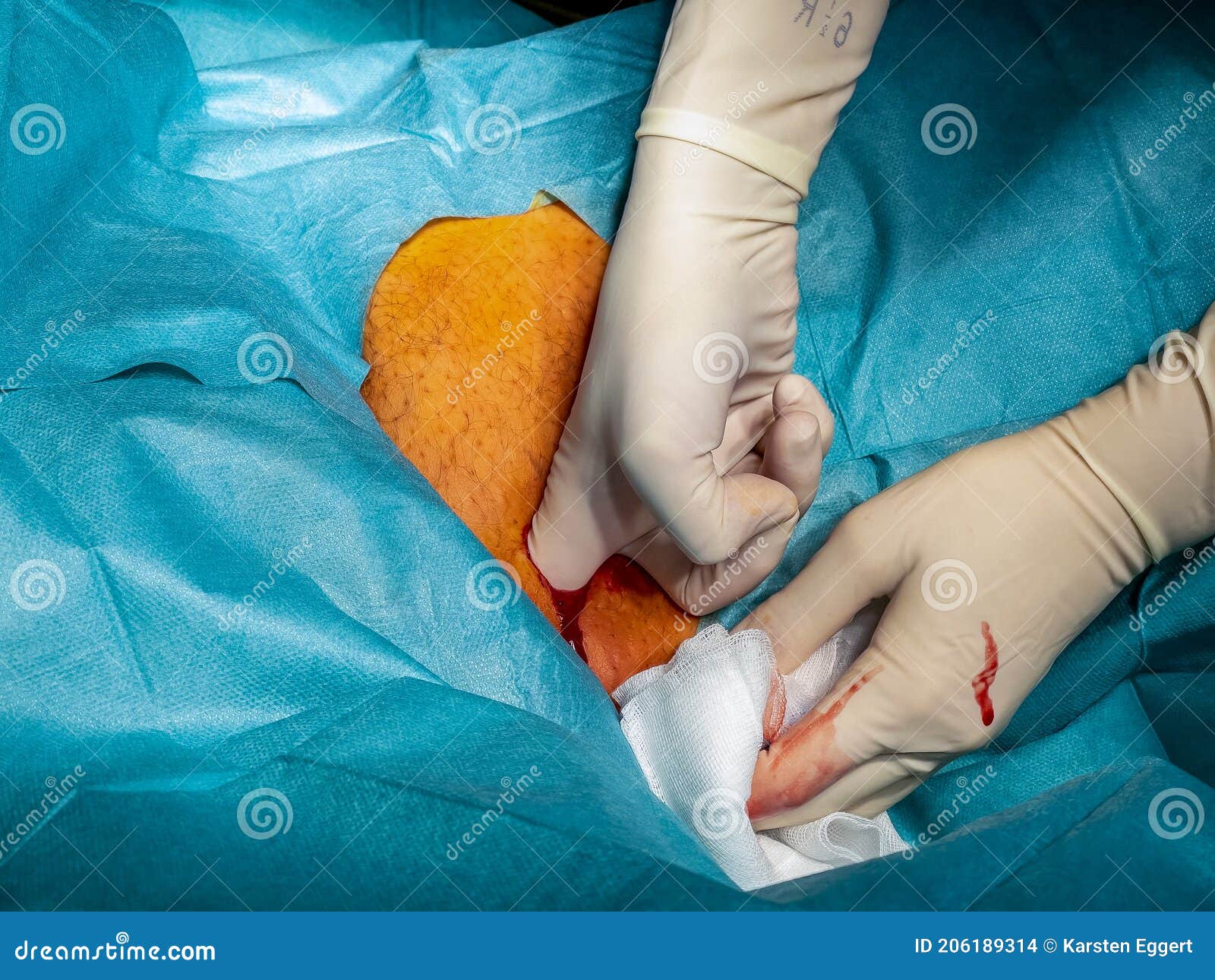 In the Operation an Abscess is Opened by a Doctor Stock Photo Image of closeup, bacterial