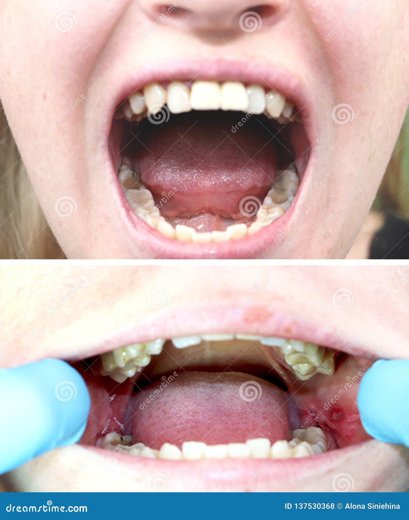 Before and after the Operation To Remove Wisdom Teeth Eights. Close