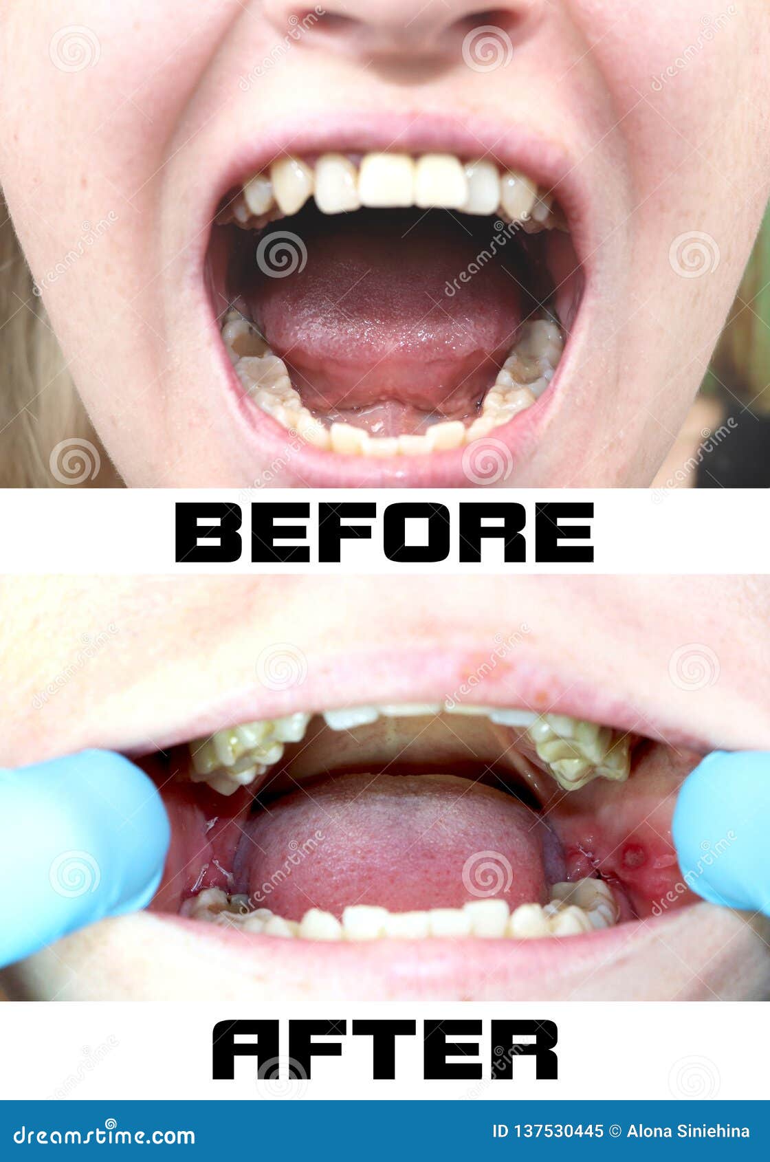 Before and after the Operation To Remove Wisdom Teeth Eights. Close