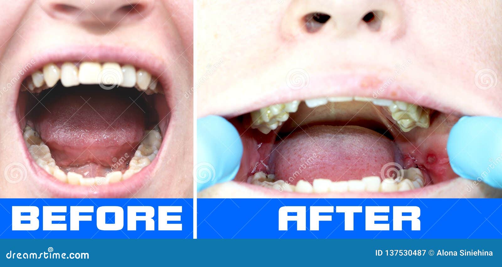 Before and after the Operation To Remove Wisdom Teeth Eights. Close