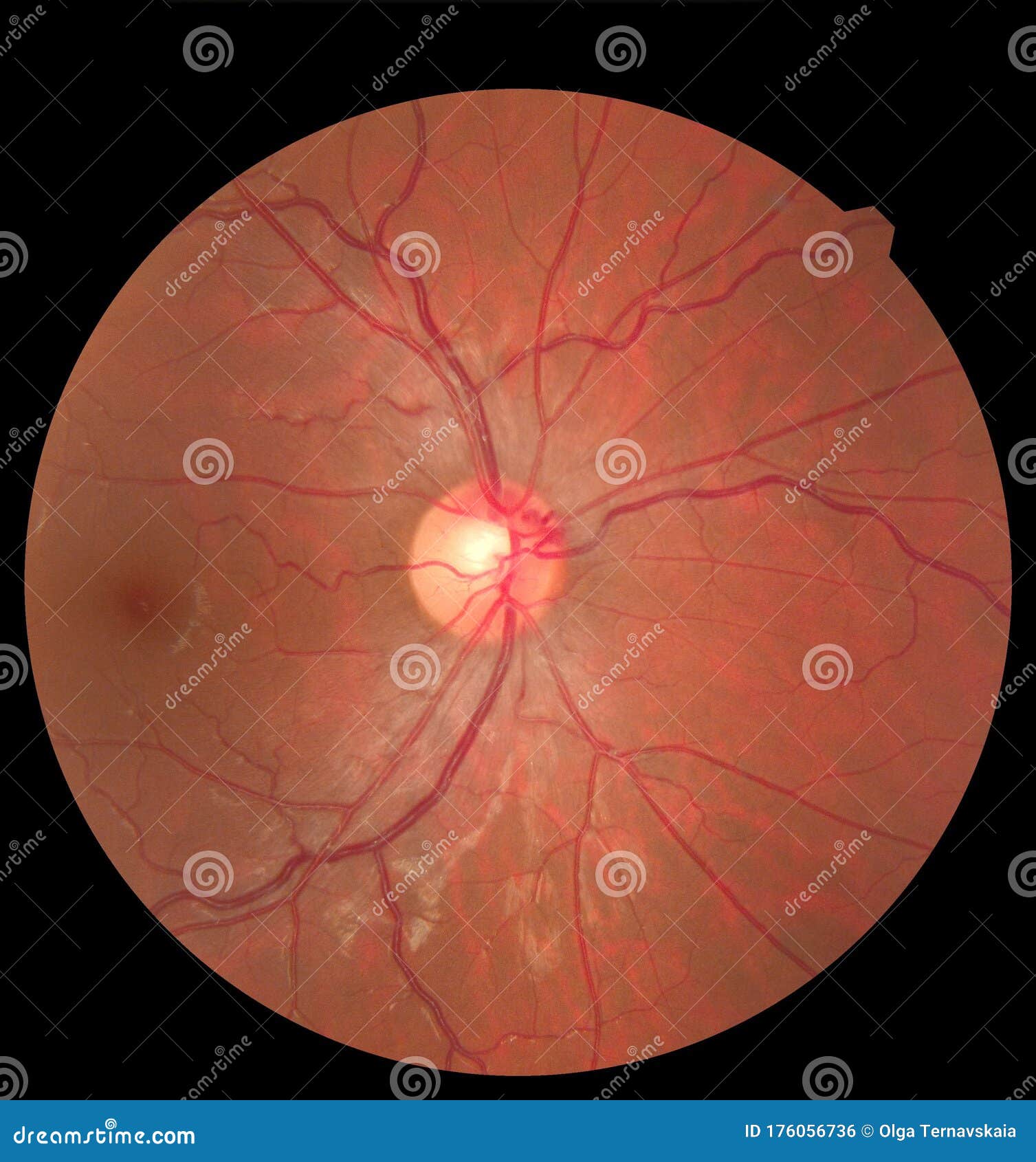 ophthalmic image detailing the retina and optic nerve inside a healthy human eye. health protection concept