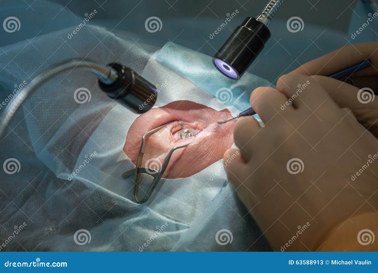 Opthtalmology Laser Operation Editorial Stock Photo - Image of operation, 63588913