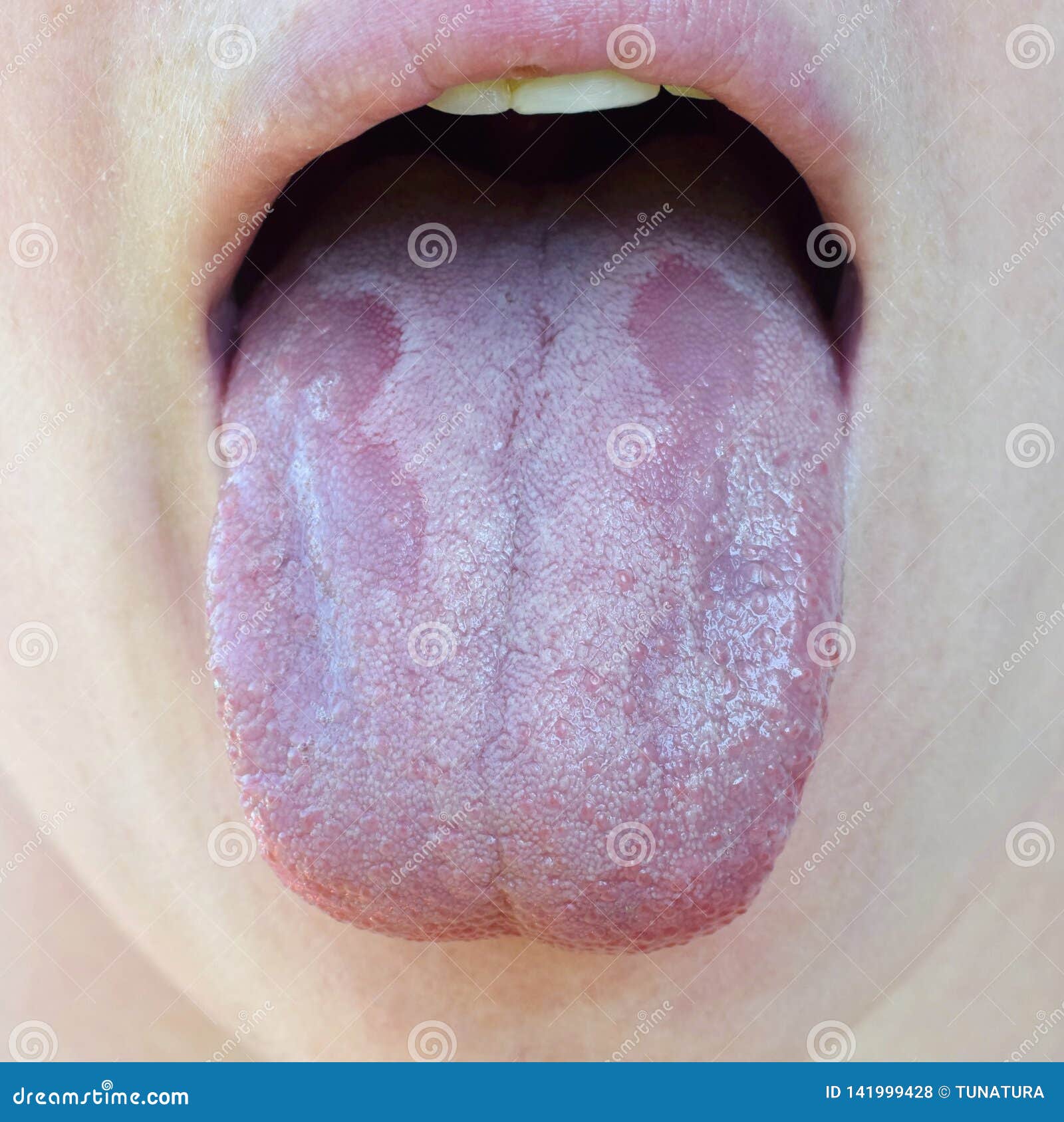 oral candidiasis or oral trush candida albicans, yeast infection on the human tongue close up, common side effect when using a