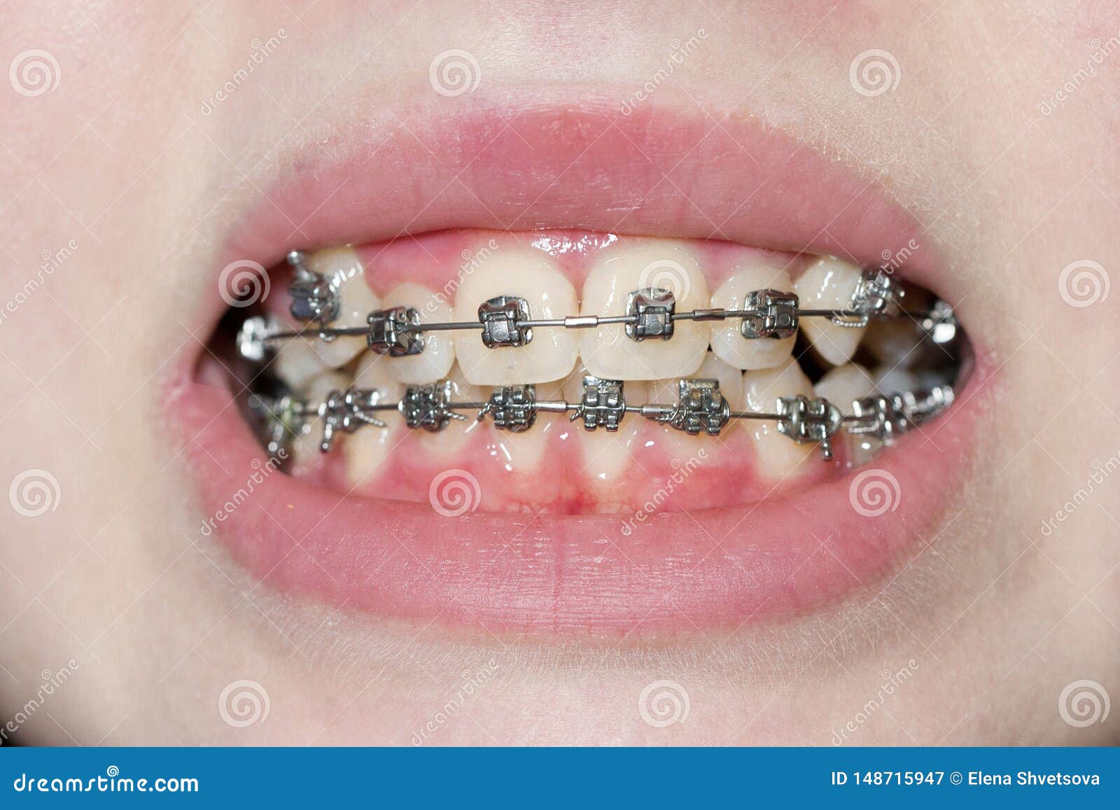 Orthodontic Braces. Close Up Stock Image Image of face, healthcare